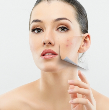 Acne treatment in muscat oman 